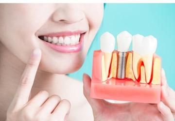 Diş İmplantları Hakkında Bilmeniz Gereken 9 Bilgi!