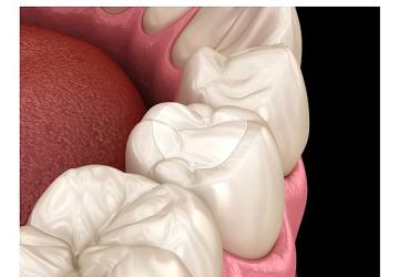 Estetik Dolguların Ömrünü Alışkanlıklarımız Belirliyor