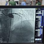 ADIYAMAN (PERRE) - Şeriban ÖZÇAKMAK - Kahta Devlet Hastanesi bünyesinde hizmete alınan anjiyo ünitesinde ilk hasta başarıyla tedavi edildi.